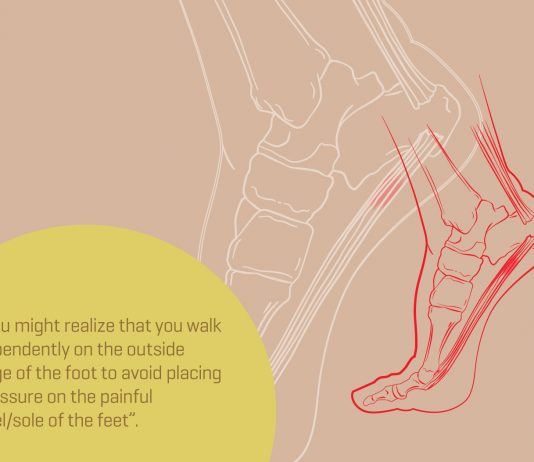 What is Plantar Fasciitis (Pfs)?